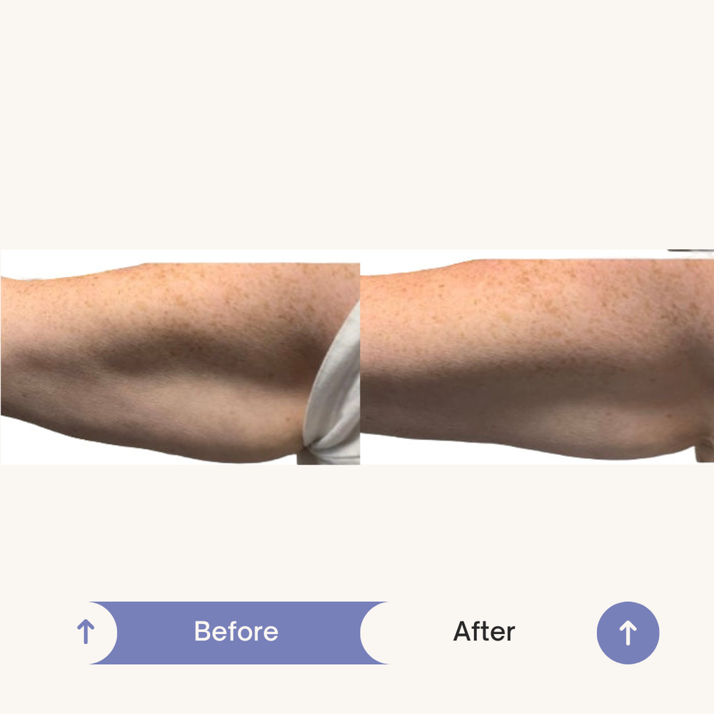 Before and After SculptMe Body Contouring Cream - Aryella Cosmetics™ #